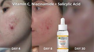 30 Days Of...Garnier Vitamin C Serum  Salicylic Acid & Niacinamide  Acne Pigmentation