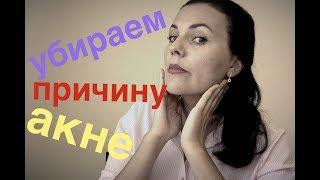 ОСНОВНАЯ ПРИЧИНА АКНЕ  КАК Я ВЫЛЕЧИЛА СЫПЬ