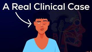 What is Bells Palsy? Causes Symptoms Pathophysiology & Treatments