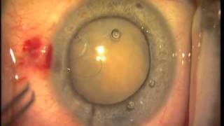 Subluxated Hypermature Cataract and Cionni Ring