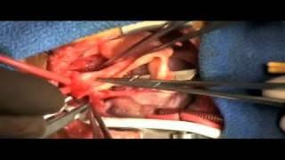 HLHS - Pediatric Heart Surgery