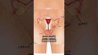 2 Types of Painful Periods 🩸 Primary Dysmenorrhoea & Secondary Dysmenorrhea #periods