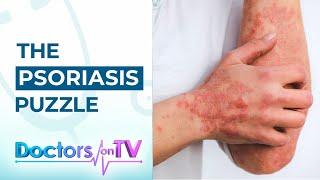 Psoriasis Know the Symptoms Causes and available Treatments from Dermatology Specialist