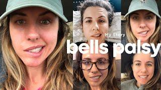 My Bells Palsy Sotry- Recovery Story & My Signs and Symptoms