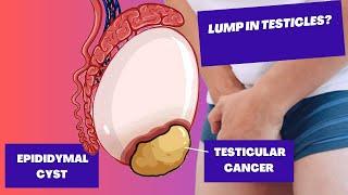 Testicular Lumps  Epididymal Cyst and Testicular Cancer