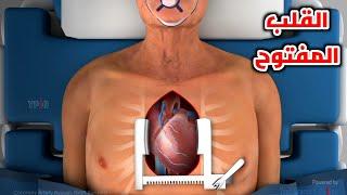 شاهد عملية القلب المفتوح خطوة بخطوة _ Heart Bypass Surgery  Step by step