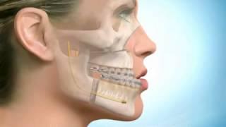 Osteotomia bi mascellare avanzamento del mascellare superiore e arretramento della mandibola
