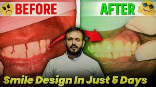 Smile Design just in 5 Days  smile designing treatment