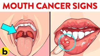 6 Early Signs of Mouth Cancer You Should Not Ignore