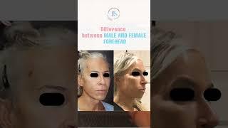 Male vs Female Forehead  Forehead reconstruction or Forehead reduction  #forehead #shorts