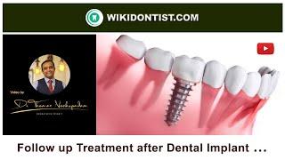 Follow up Treatment after Dental Implant ...  Video by Dr.Thomas Nechupadam