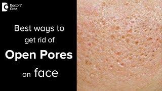 What are open pores and treatment options for that? - Dr. Vignesh Raj