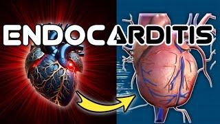 Endocarditis  دل میں جراثیم  Dow University AHN