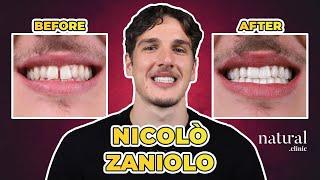 Nicolo Zaniolos Dental Treatment A Smile Makeover #NicoloZaniolo #Hollywoodsmile #smilemakeover