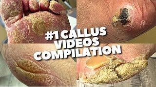 Super Crusty Callus Removal Compilation So Satisfying