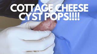 Ooey Gooey Nacho Cheese Cyst EXPLODES  CONTOUR DERMATOLOGY