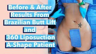 Before and After Results From Brazilian Butt Lift BBL and 360 Liposuction A-Shape Patient