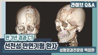 경피증선천성 안면기형 환자 만 3년 경과 CT입니다.