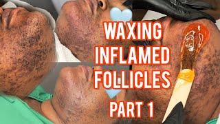 Waxing Inflamed Follicles Part 1  NEW Client Alert This Is #Hirsutism