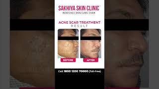 Results of Acne Scar Treatment. #acnetreatment #clearskin #acnescars #scartreatment