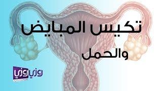 تكيس المبايض والحمل