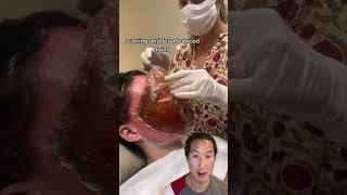 Watch Her Skin Get Lifted Off Her Face #phenol #chemicalpeel