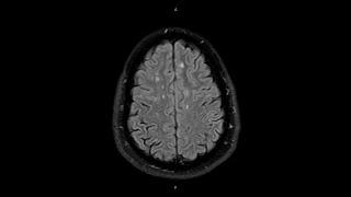 Brain Fluid-Attenuated Inversion Recovery FLAIR Magnetic Resonance Imaging MRI