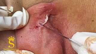 Pimples Behind The Ears  Nổi Mụn Sau Tai - SacDepSpa#126