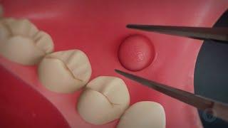 Phẫu thuật cắt u nang miệng bằng laser