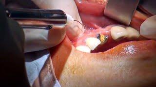 Trồng răng cửa bằng phương pháp cấy ghép implant