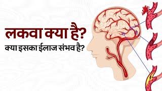 Treatment of Stroke  लकवा का सबसे अच्छा इलाज। ब्रेन स्ट्रोक। पैरालिसिस