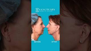 Check out these facelift results