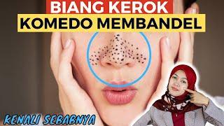 KENAPA KOMEDO DI WAJAH MUNCUL TERUS??