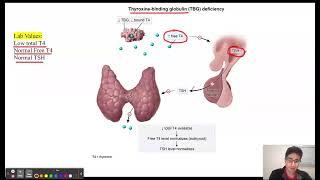 Thyroxine Binding Globulin TBG Deficiency