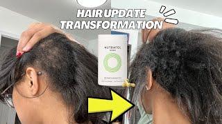 HUGE HAIR Transformation + Hair Loss & CCCA Update honest Nutrafol review