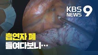 폐 내시경 영상 입수…‘30년 흡연 폐’ 모습 충격  KBS뉴스News