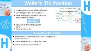 Acute Brachial Neuritis-Upper limb clinicalsbrief explanation brachial plexus injury