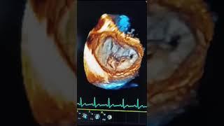 Prolapse of PMLP 1 with Severe Eccentric MR in 3D Echocardiography