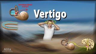 Vertigo Causes Pathophysiology and Treatments Animation