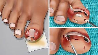 ASMR Help Jackie Chan remove glass shards stuck in her big toe  Ingrown Toenail Removal Animation