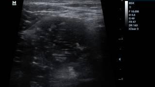 Ultrasound guided injection of iliopsoas bursitis 1