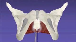 Autologous apical sling for Level I and anterior defect repair