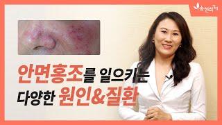 얼굴이 붉어지는 안면홍조? 주사피부염 지루성피부염 연고 오남용으로 인한 피부염