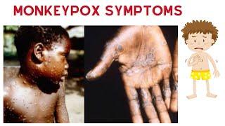 Monkeypox symptoms