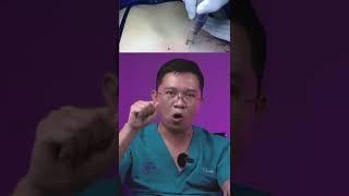 BÍ MẬT ĐẰNG SAU XOÁ XĂM BẰNG LASER BÁC SĨ LƯƠNG