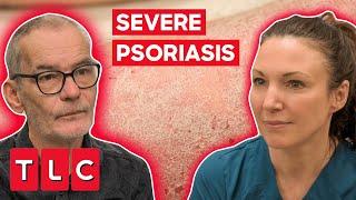 Dr. Emma Treats a Severe Case Of Psoriasis  The Bad Skin Clinic
