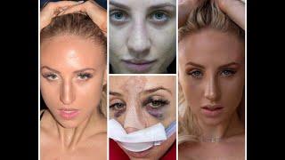 NOSE JOB RECOVERY PROCESS-FROM CONSULT TO SURGERY TO CAST OFF