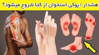 علائم اولیه پوکی استخوان وعلل  از کجا شروع میشود Osteoporosis Causes & Symptoms and Signs