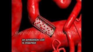 Embolization of arteries video - Animation by Cal Shipley M.D.