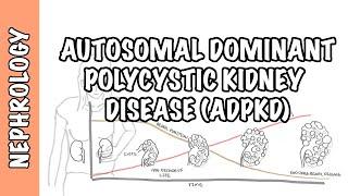 Autosomal Dominant Polycystic Kidney Disease ADPKD - causes pathophysiology diagnosis treatment